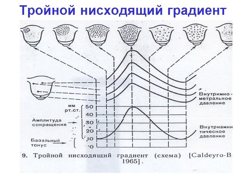 Тройной нисходящий градиент